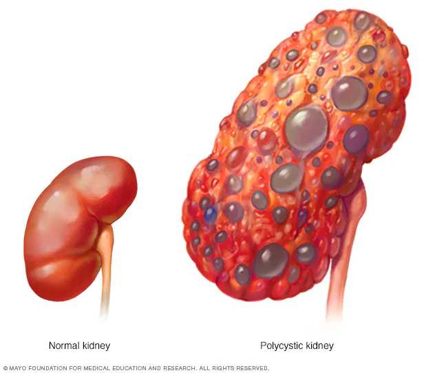Kidney disease rising in N/East, experts raise alarm